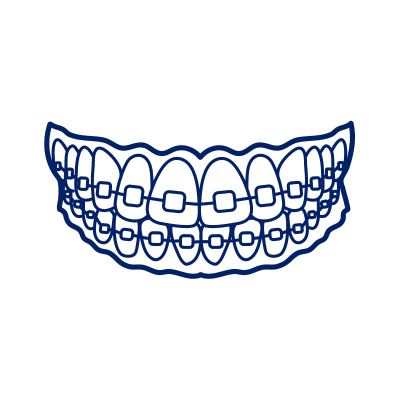 Dental Braces