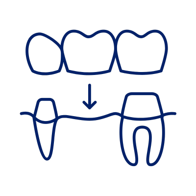 Dental Bridges and crown